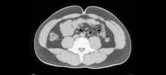 CT内臓脂肪計測
